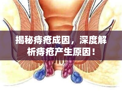 揭秘痔疮成因，深度解析痔疮产生原因！