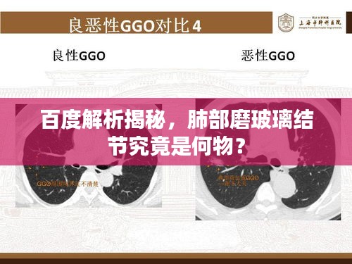 百度解析揭秘，肺部磨玻璃结节究竟是何物？